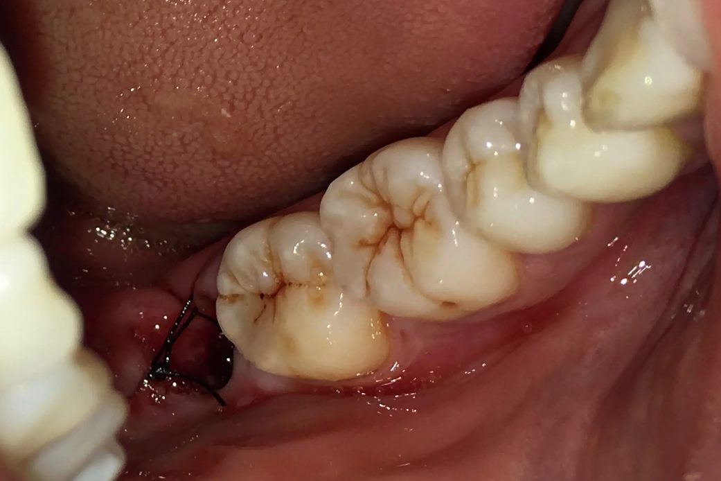 智齿拔完后的伤口