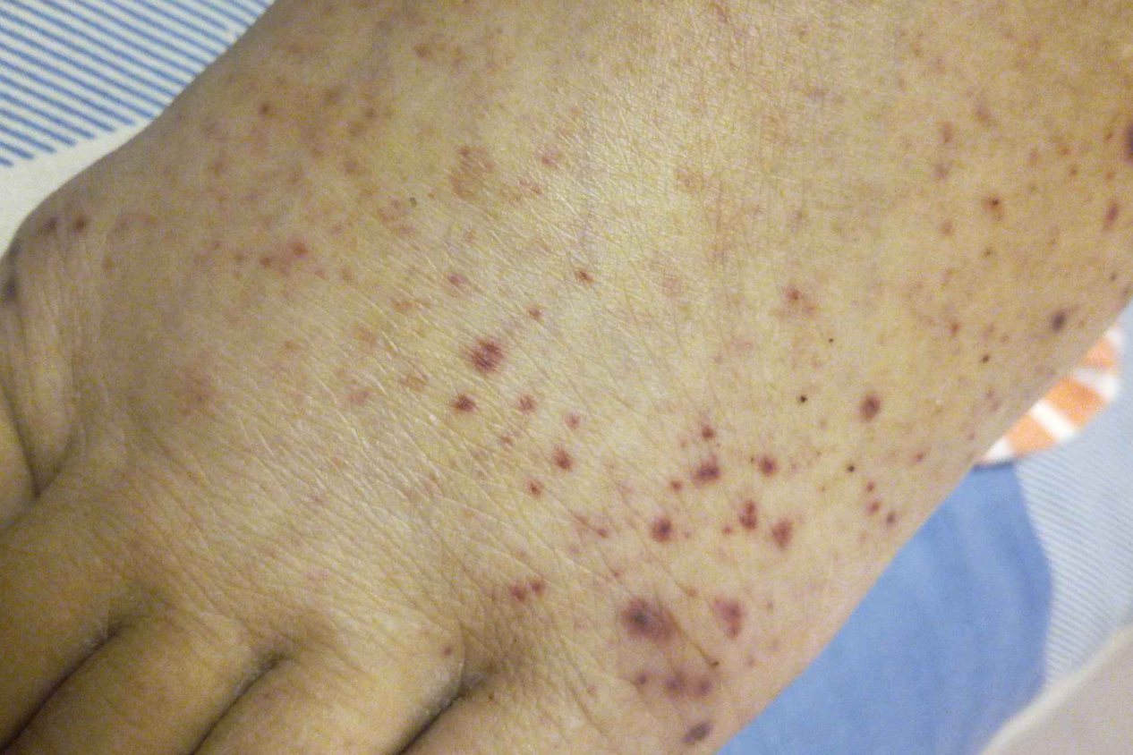 朗格汉斯初期皮疹