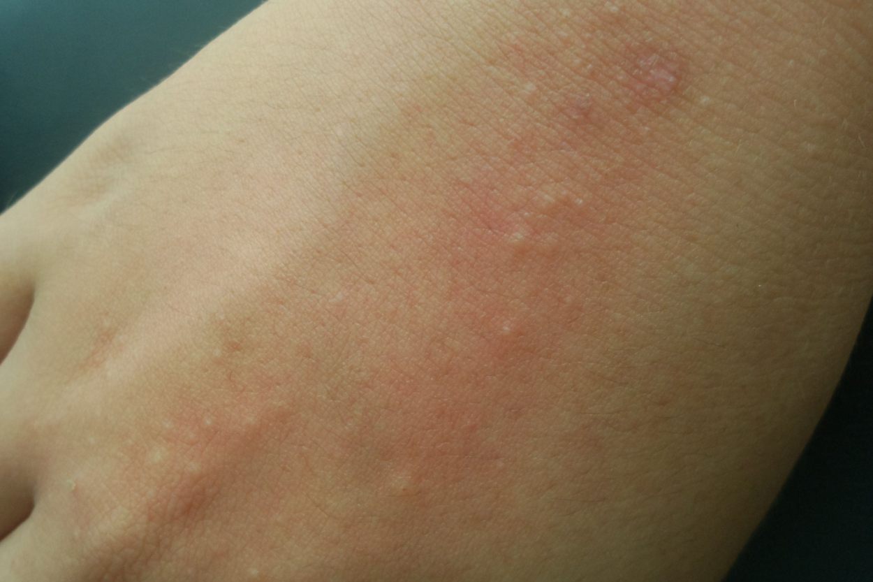 苍蝇引起的皮肤过敏