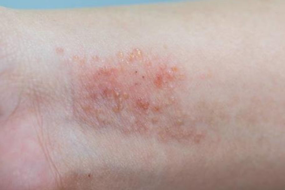 手臂脂溢性皮炎