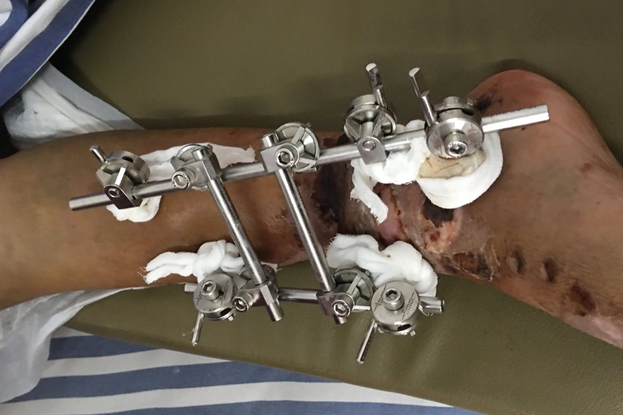 骨折外固定支架