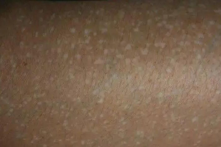 特发性点状白斑