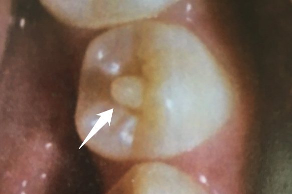 畸形中央尖图片