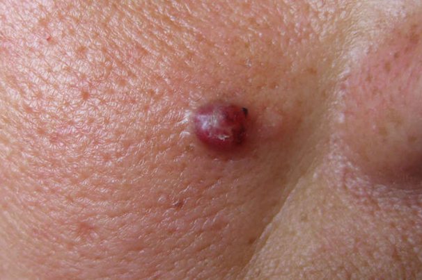 皮肤癣菌肉芽肿