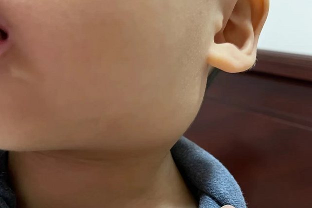 颈部淋巴结炎