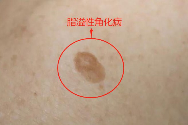 脂溢性角化病初期图片