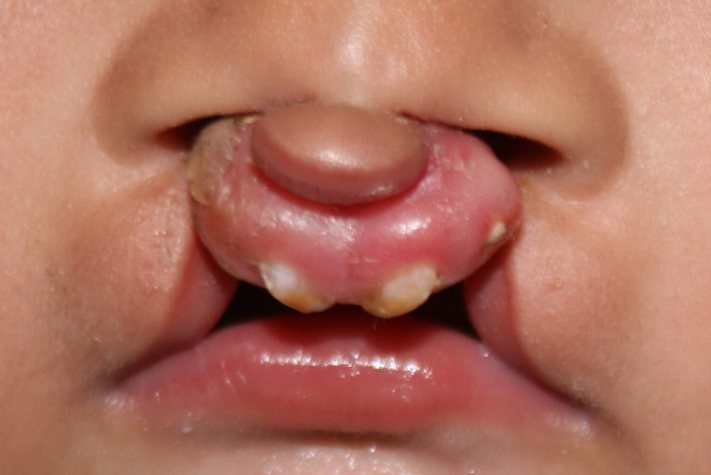 双侧完全性腭裂