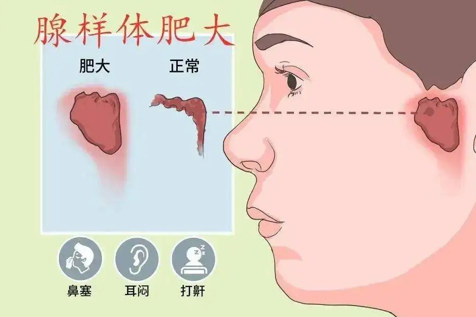 儿童腺样体肥大