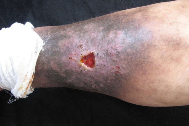 静脉曲张性溃疡