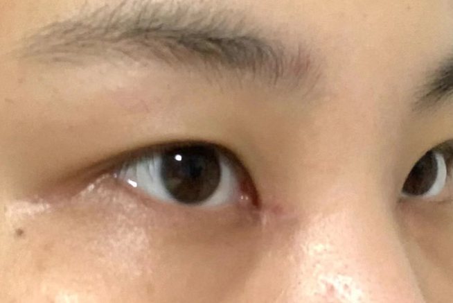 内眼角开大修复