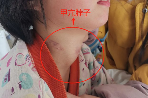 甲亢脖子粗图片