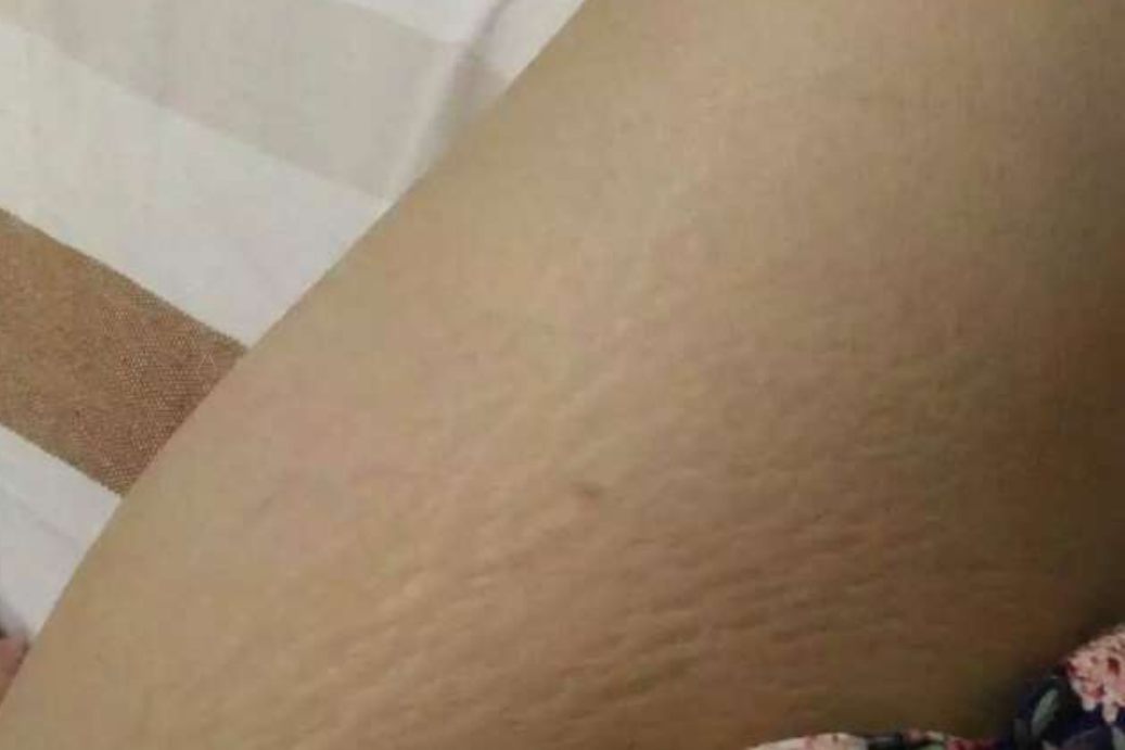 激光去除肥胖纹前