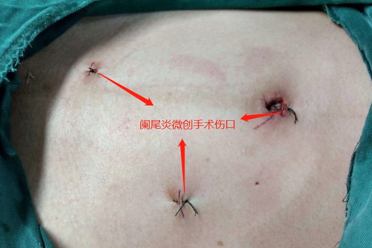 阑尾炎腹腔镜手术疤痕