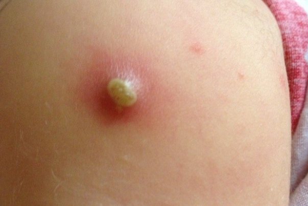 卡介苗正常化脓