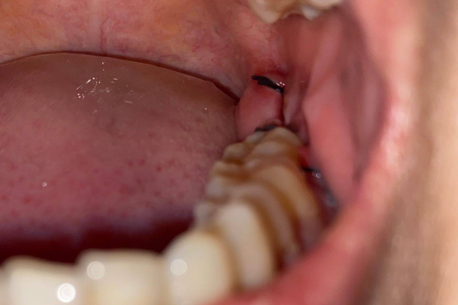 拔智齿后三天的正常伤口