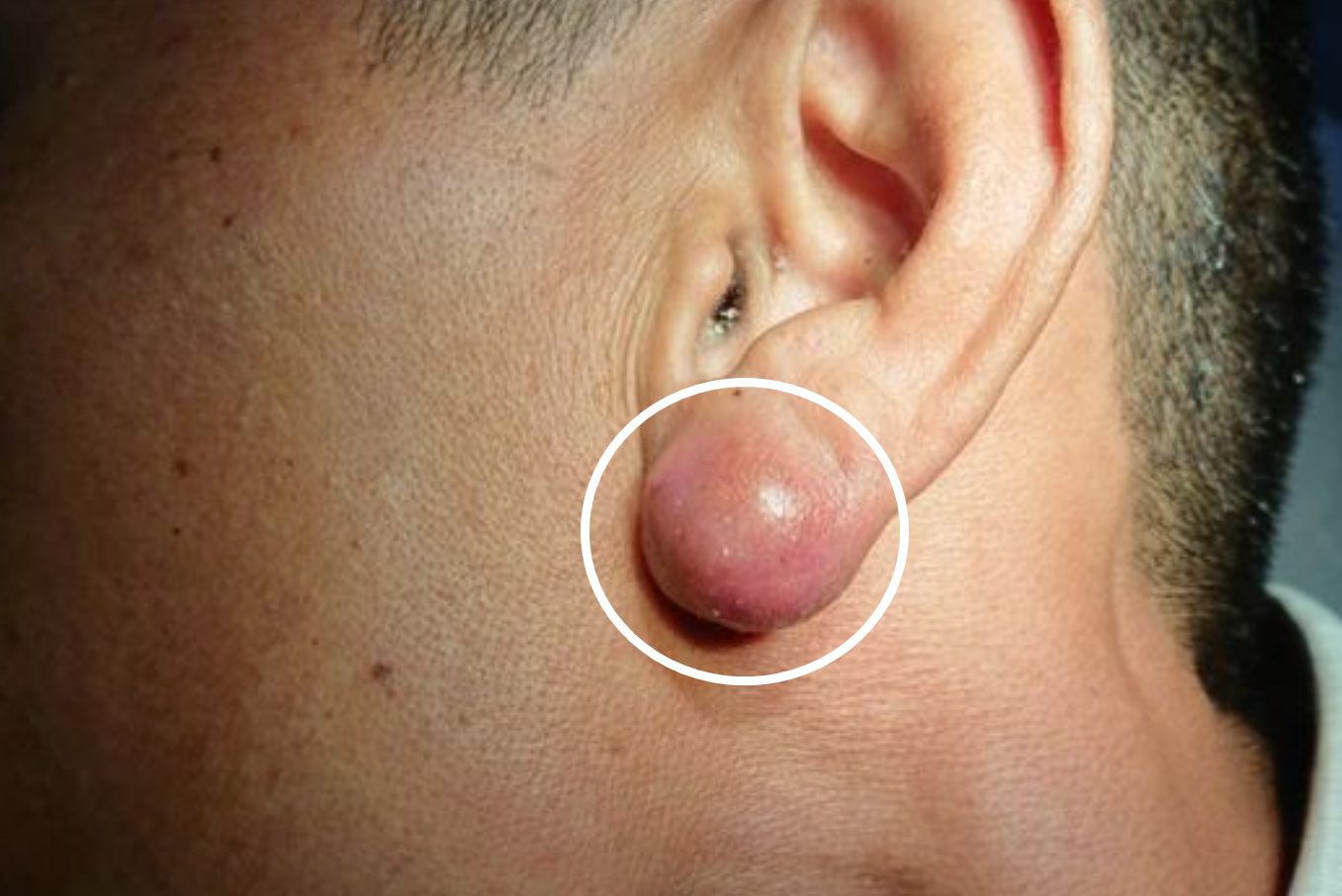 粉瘤感染化脓