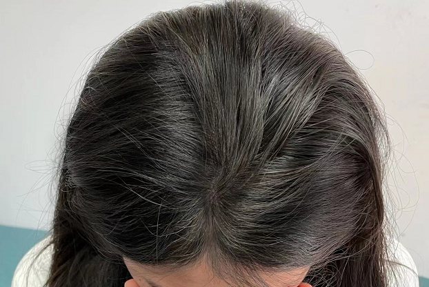 正常头发密度图片