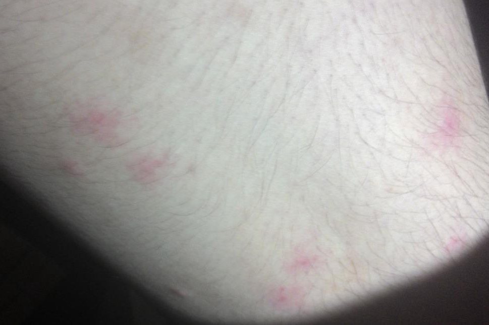 被跳蚤咬了的症状