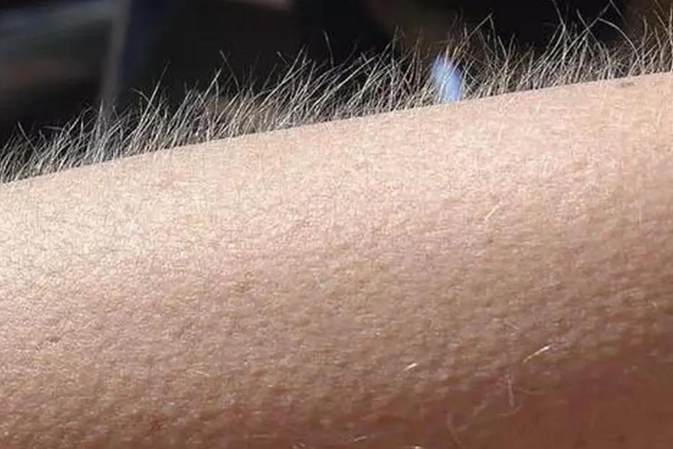 胳膊上有鸡皮疙瘩