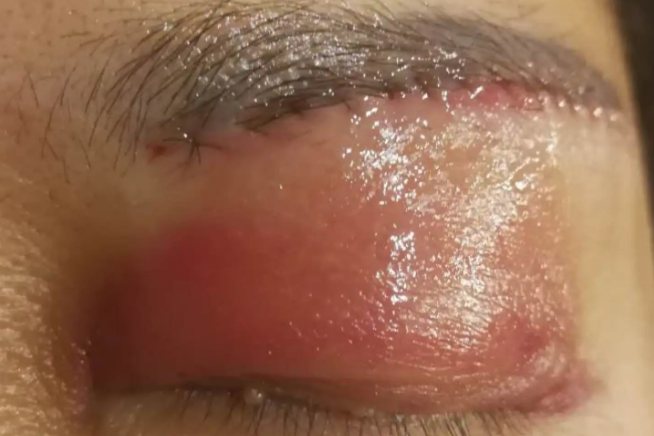 切眉手术第二天的照片