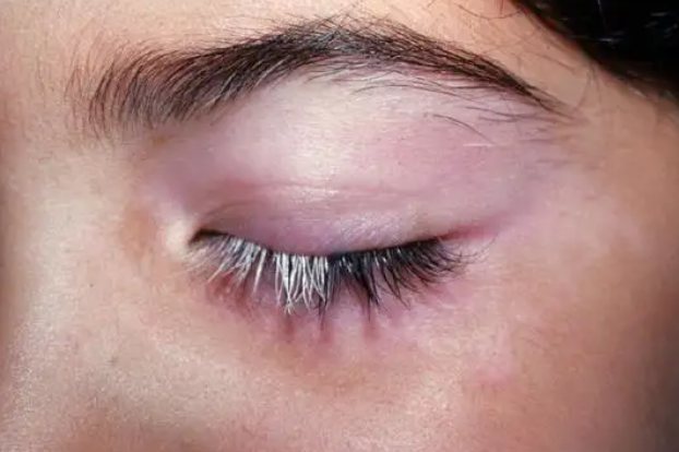 先天局限性白发病