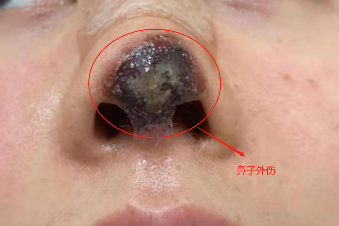 鼻子外伤