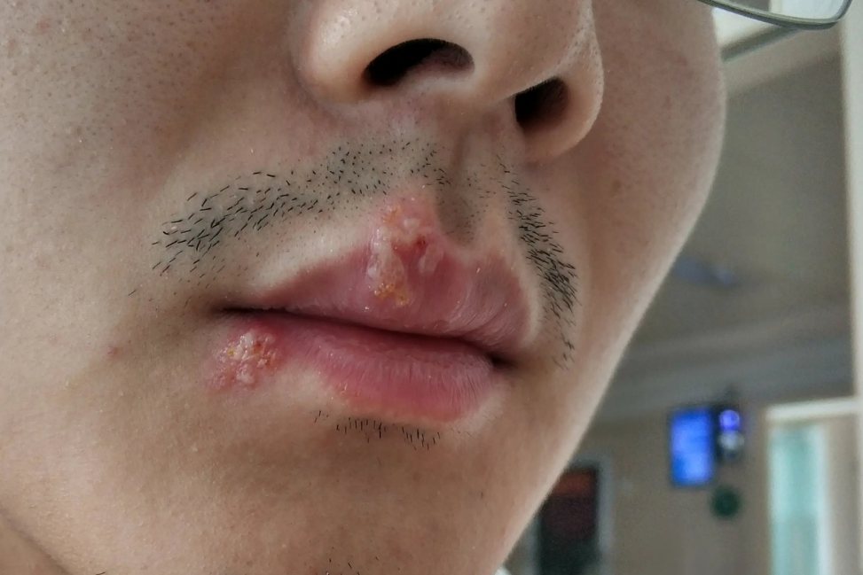 单纯疱疹病毒感染