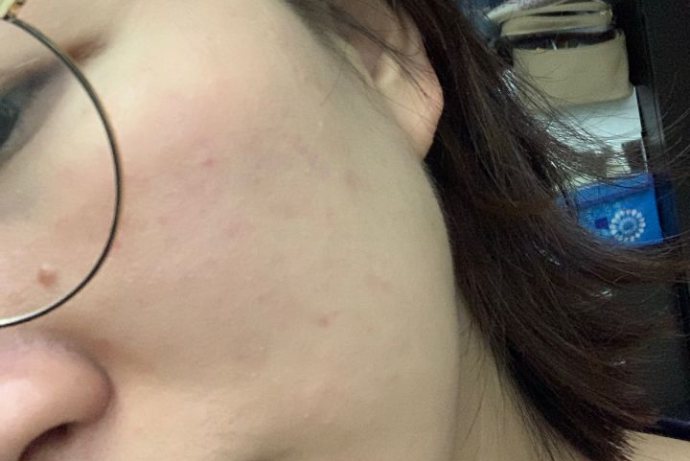 用激光打完瘊子一年后