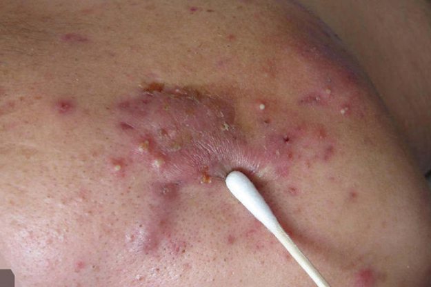 痘痘留下的增生性凸疤