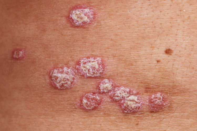 寻常型银屑病早期症状