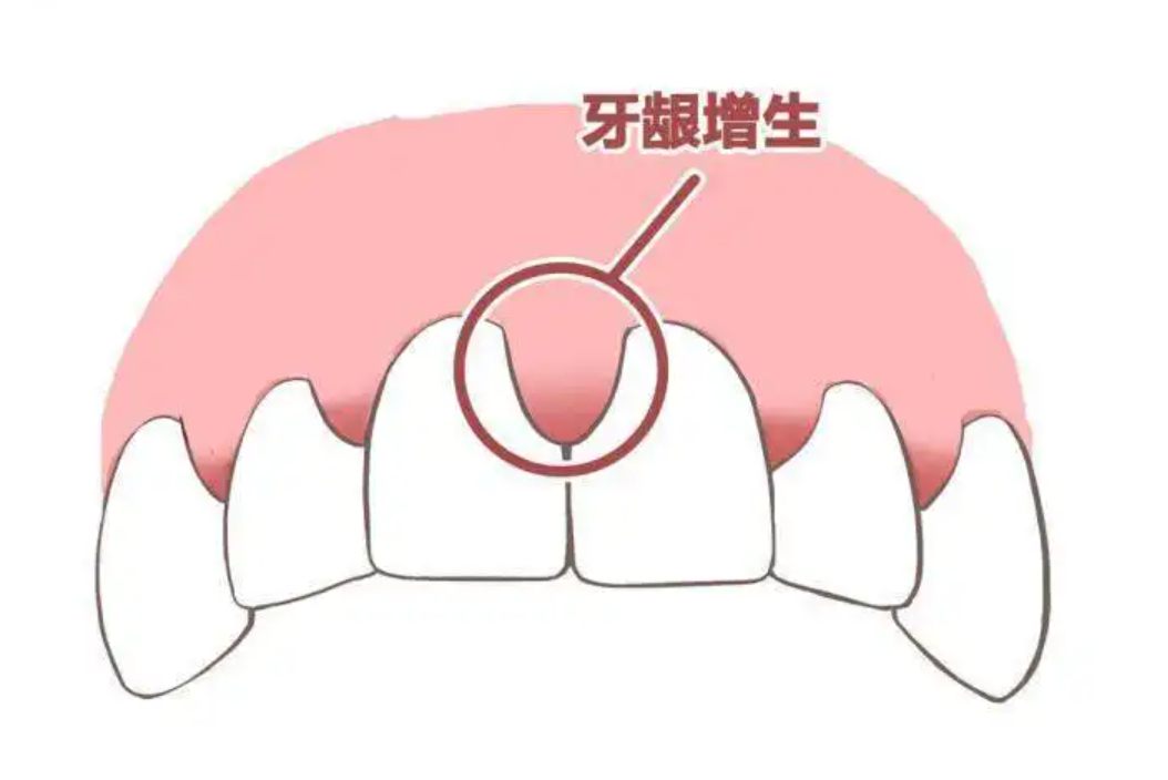 牙龈增生