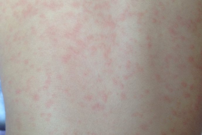 高烧退后的疹子