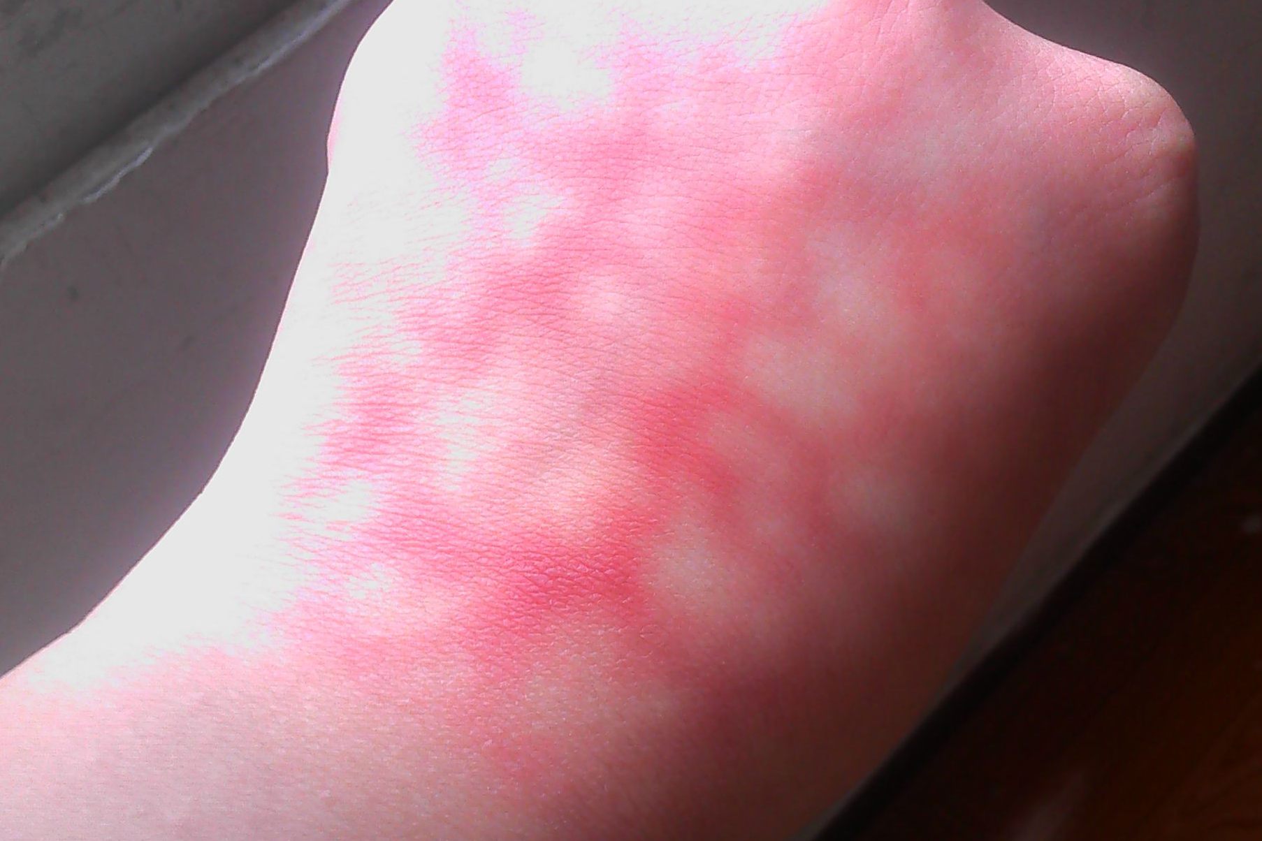 毛细血管扩张症