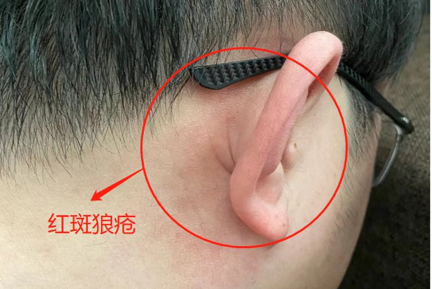 轻度红斑狼疮10