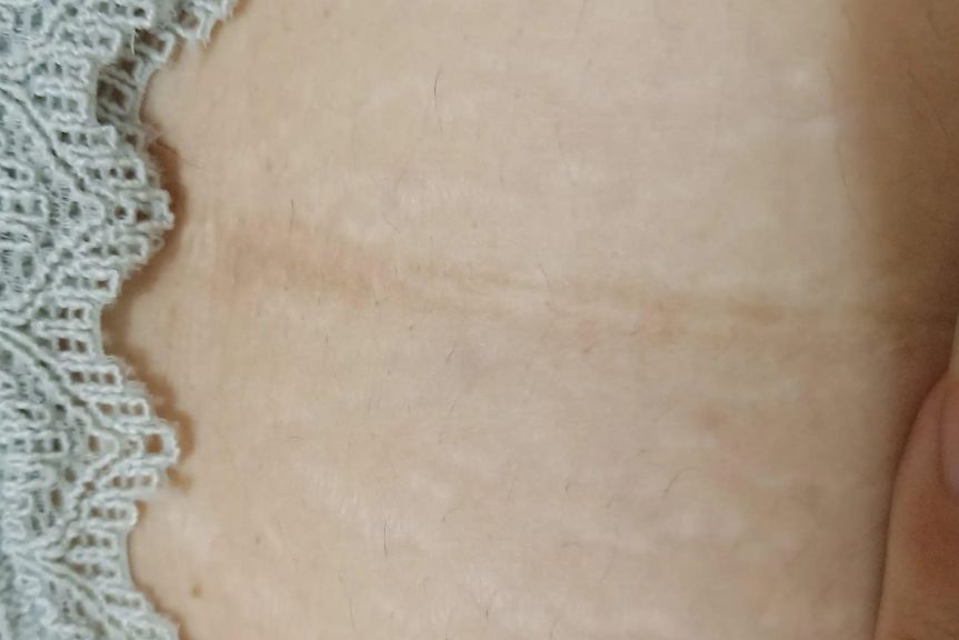 剖腹产疤痕修复后