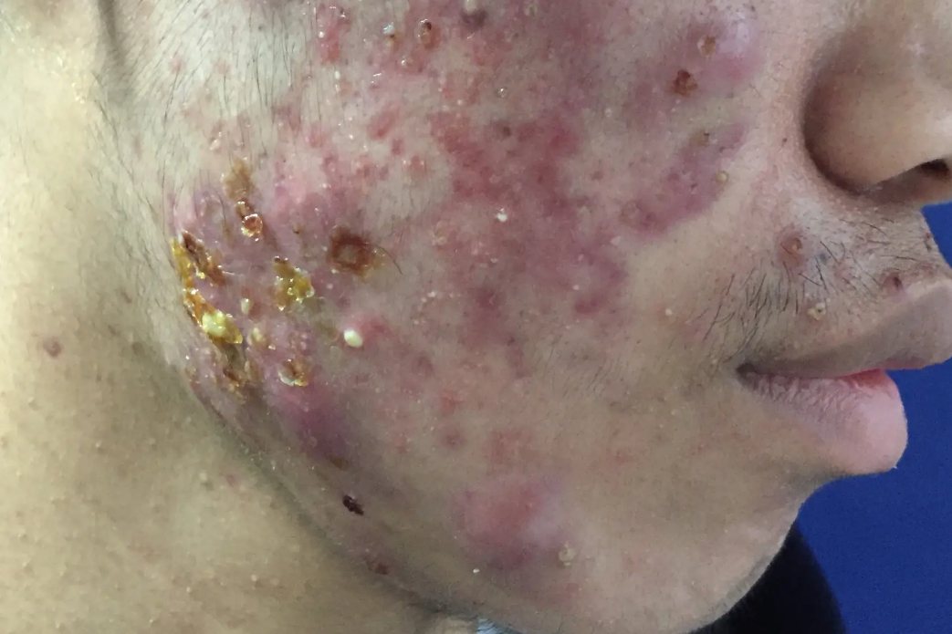 闭口挤完红肿发炎