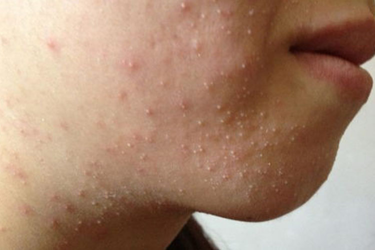 早熟性皮脂腺增生图