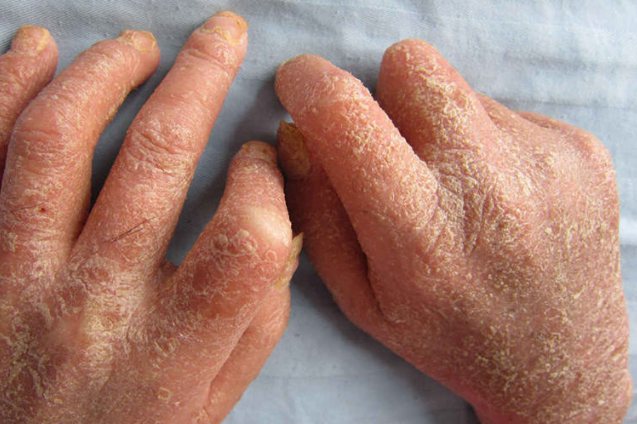 关节病型银屑病