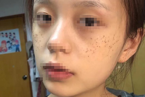 激光祛斑10天后