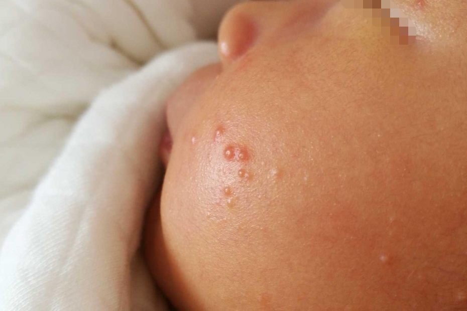 脸上水泡型湿疹图片