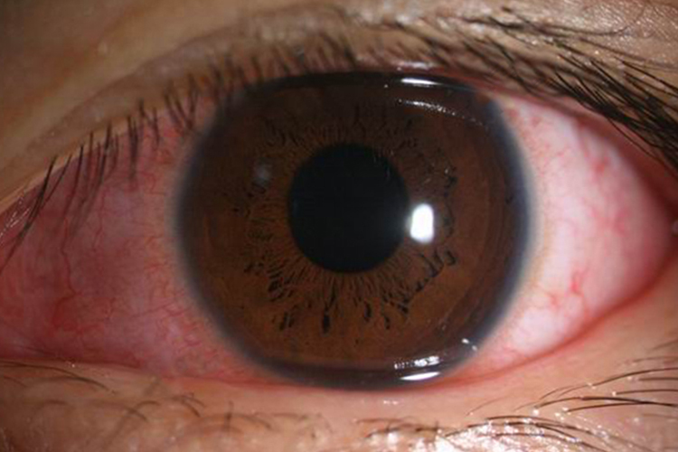 病毒性结膜炎分泌物图