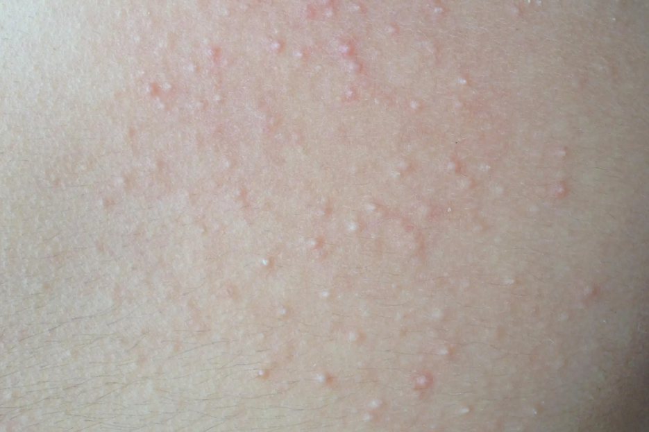 丘疹