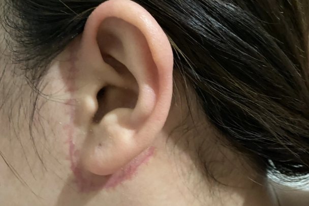 拉皮手术疤痕图片