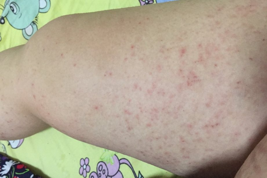 胆汁酸引起的红点