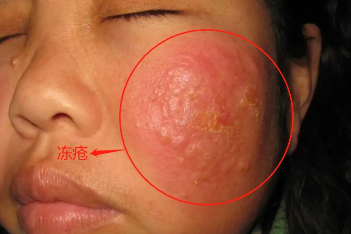 脸上冻疮
