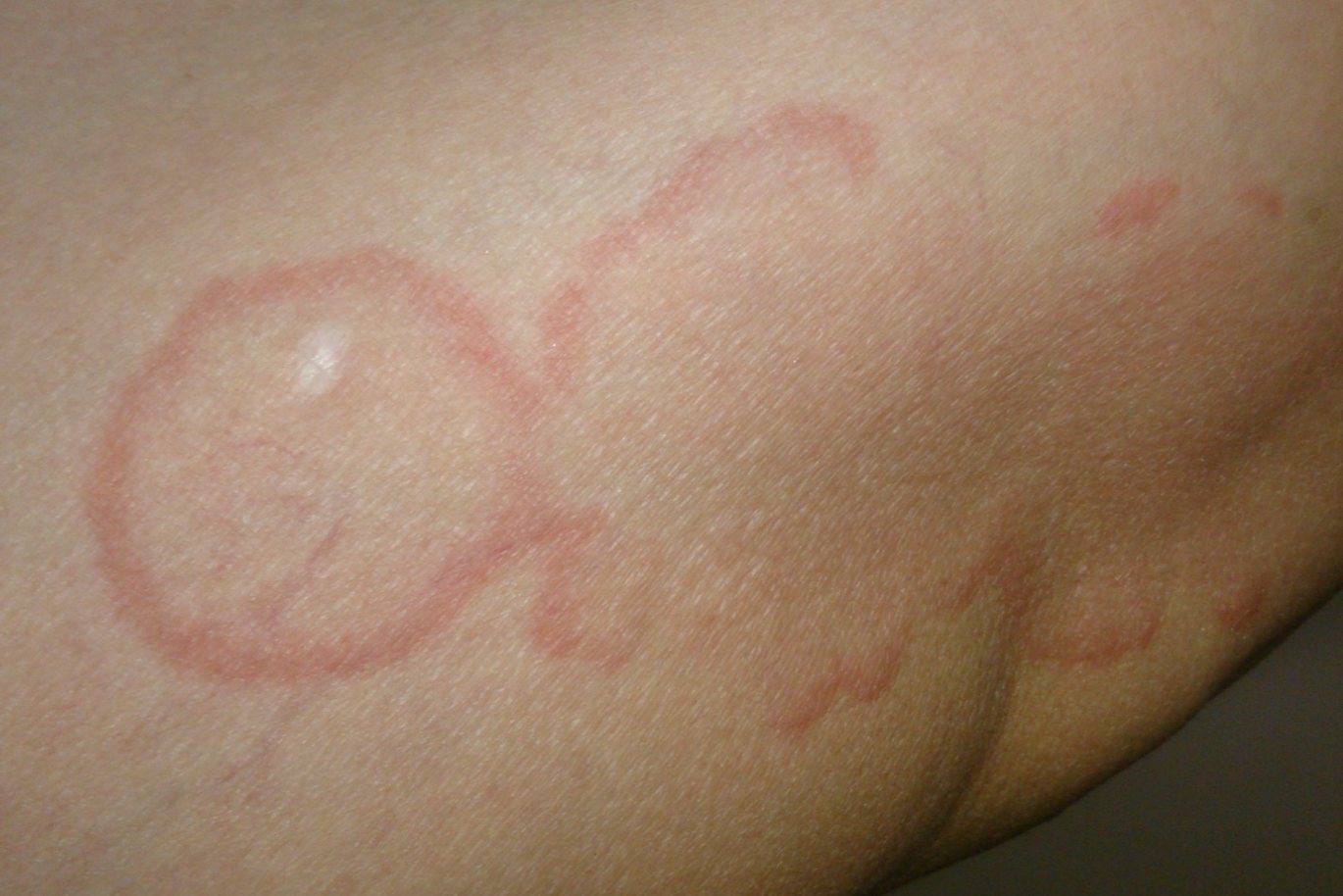 荨麻疹环形红斑图片