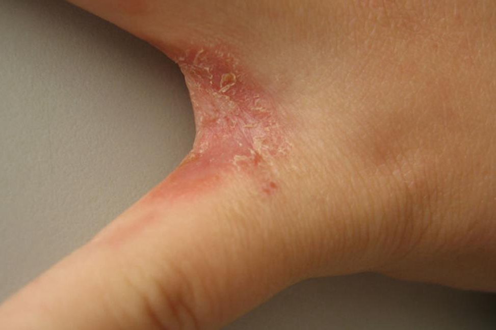 手部过敏性湿疹