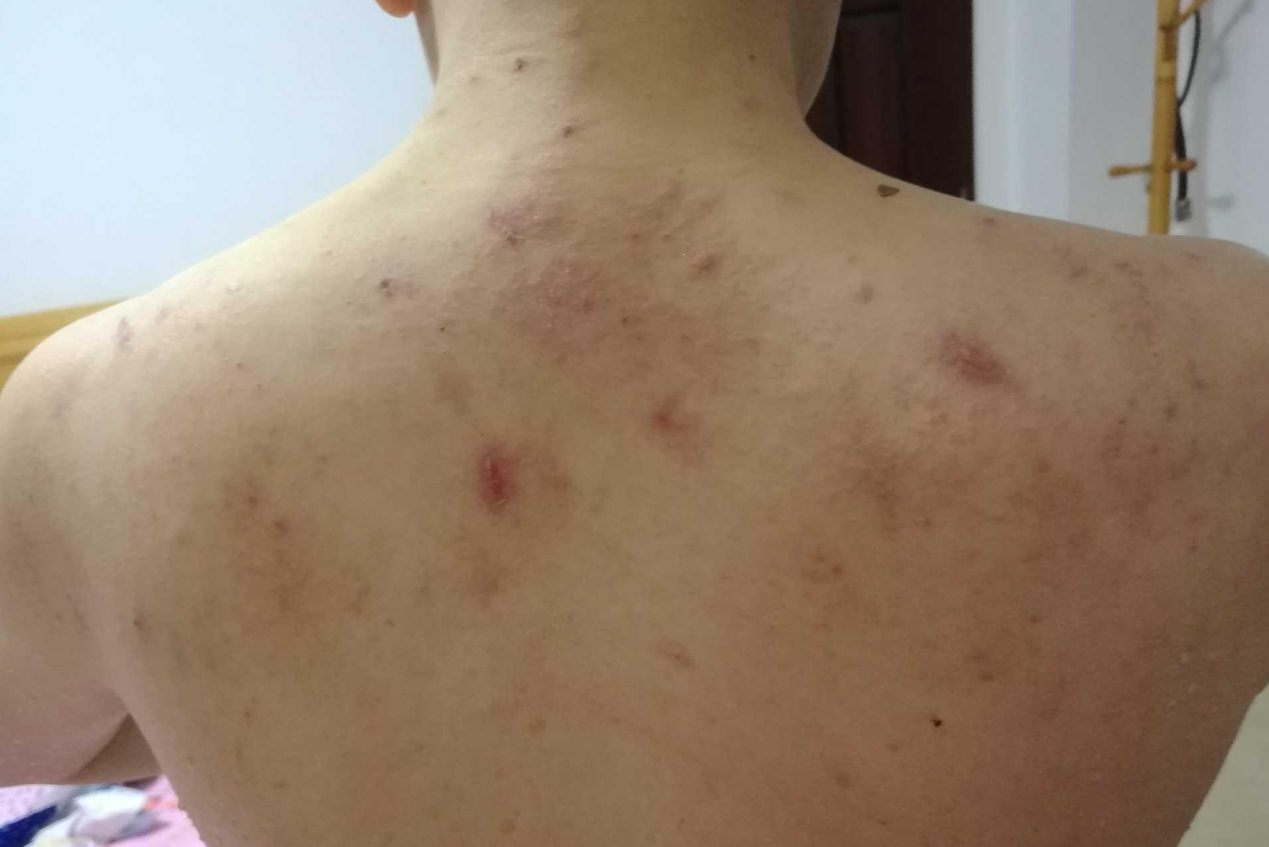 肩膀湿疹图片