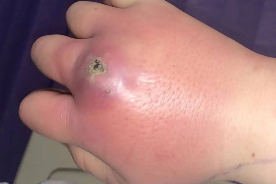 蜘蛛毒的皮肤症状