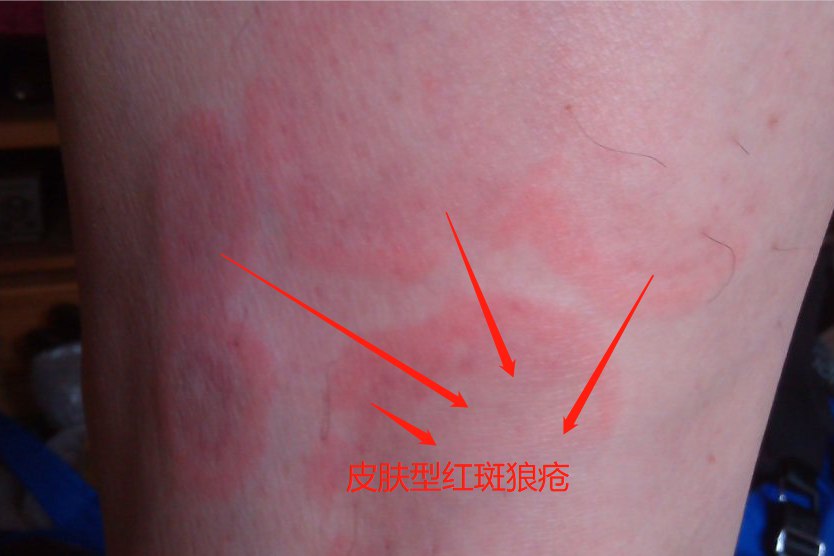 皮肤型红斑狼疮